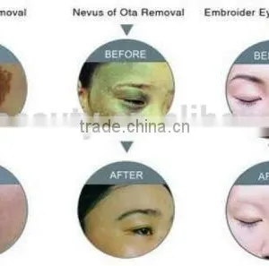 2015 Chrismas Promotion USd1200!! ND Yag Laser Tattoo Remover Portable / Mini Home Use Tattoo Removal nd Yag Laser thumbnail-5