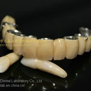 Dental Crown Composite, Dental Teeth, Dental Prosthesis, Laboratoire Dentaire, Dentallabor, Laboratorio Dental, Dental Laboratory, Shenzhen LJ Dental Lab China thumbnail-1