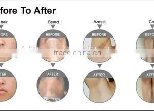 Discount Screen Logo Customized Nd Yag Laser Hair Removal Nd Yag Laser Ipl thumbnail-2