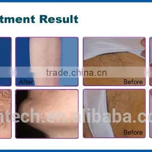 CE ISO Approved Portable Medical 808nm Diode Laser Hair Removal Machine With 160J/cm3 Energy thumbnail-2