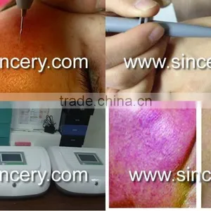 High Frequency Vascular Removal Red Spider thumbnail-3