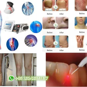 Clinic Use Diode Laser Device 980nm 1470nm Combined Two Wavelength Physical Therapy Vascular Removal Nail Fungus Removal thumbnail-4