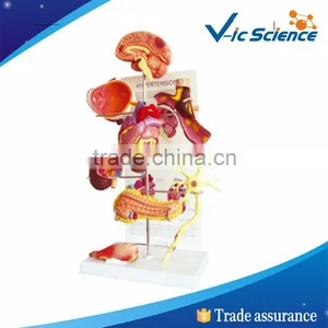 High Quality Diabetes Model thumbnail-1