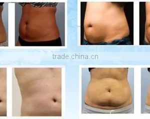 Best Sell Product Cryolipolysis Fat Freeze Loss Increasing Muscle Tone Weight Slimming Belts Machine For Spa Clinic Hospital 50 / 60Hz thumbnail-5