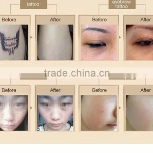 800mj New Styel Laser Picosure/laser Tattoo Removal Machine Price Pigmented Lesions Treatment thumbnail-5