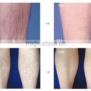Salon 2016 Permanent Hair Removal SHR IPL/SHR IPL Laser/SHR IPL Hair Removal Machine Pigment Removal thumbnail-6