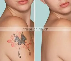 0.5HZ Q Switched Nd Yag Pigmented Lesions Treatment Laser Tattoo Removal Beauty Equipment thumbnail-6