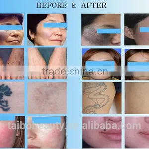 Best Selling Skin Rejuvenation 1064nm 532nm q Switch nd Yag Laser Tattoos Removal Clinic Medical Machine uk Distributor Wanted thumbnail-6