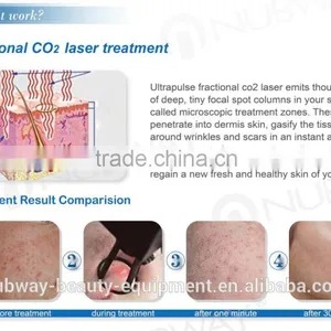 Ultra Pulse Pigmentation Removal CO2 Laser Resurfacing Machine thumbnail-3