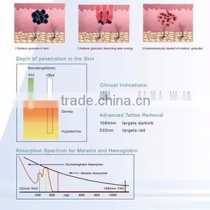 Professional Germany Laser Tan Removal Machine/skin Type Mongolian Spots Removal Vertical Nd Yag Laser Hair Removal Machine Q Switched Nd Yag Laser Tattoo Removal Machine thumbnail-4