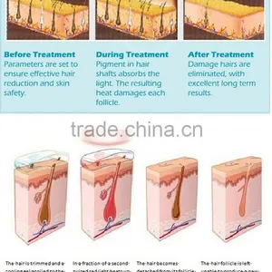 CE Approved Best Quality IPL Laser Hair Removal Machine / Skin Rejuvenation IPL RF Machine thumbnail-5