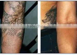 Q-switched Ndyag Laser,professional for Tattoo,pigment ,eyebrow Removal thumbnail-6