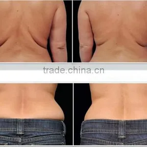 Factory Provide Cryolipolysis Increasing Muscle Tone Fast Slimming Machine Cellulite Reduction thumbnail-6