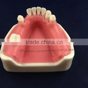 Medical Science Dental Implant Model With Soft Gingiva thumbnail-1