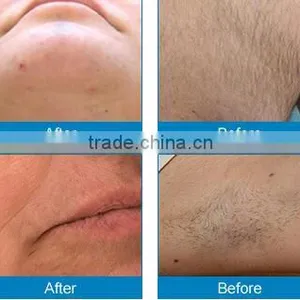 Fine Lines Removal Wholesale Price Multifunctional Medical E-light Ipl And Rf For Hair Removal thumbnail-5