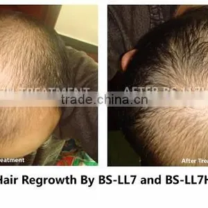 Laser Hair Loss Treatment/ Hair Growth Machine/ Laser Hair Regrowth Massage Machine From Factory Direct Sales thumbnail-4