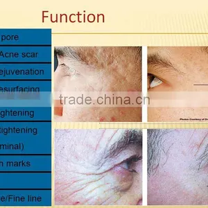 New Technology Professional Wrinkle Remove PINXEL rf Fractional Micro Needle Machine / Micro Needle rf / Vein Stopper thumbnail-6
