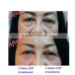 Hotsale Always CDT Carboxytherapy Instrument, CDT Carboxytherapy thumbnail-5