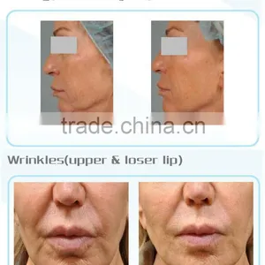 Latest Technology HIFU Ultrasound Facial Treatment Equipment thumbnail-5