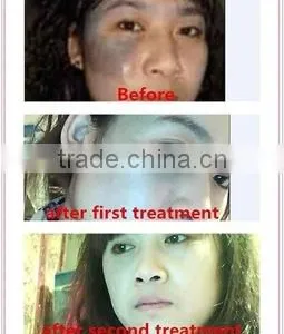 Q Switch nd Yag Picosecond Laser High Power Tattoo Pigmentation Birthmark Removal From Laser Beauty Salon Equipment Supplier thumbnail-5