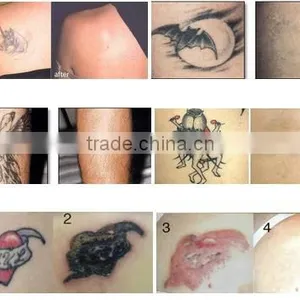 Facial Veins Treatment Fashionable Updated Beauty Nd 1000W Yag Machine For Tattoo Laser /scar Removal 532nm thumbnail-6