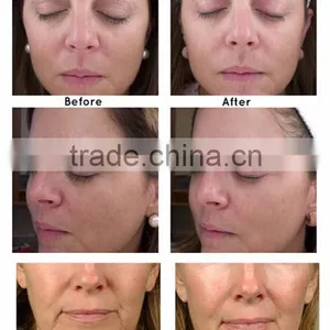 Skin Tightening HIFU Machine Anti Wrinkle 5.0-25mm Machine High Intensity Frequency Hifu Facial Machine 4MHZ thumbnail-6