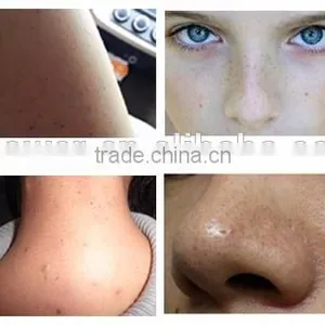 2017 Most Popular Blackhead Remover Vacuum Blackhead Remover thumbnail-6