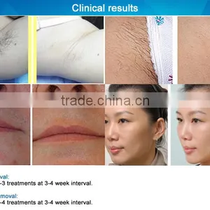 Shrink Trichopore Ipl Shr Hair Removal Machine Vertical Spa Vertical thumbnail-6