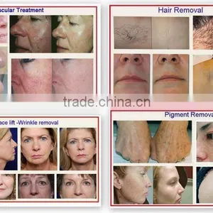 Vascular Treatment Best Effective And High Quality Portable Ipl 2.6MHZ Hair Removal Skin Care Machine For Home Use And Hospital 10MHz thumbnail-6