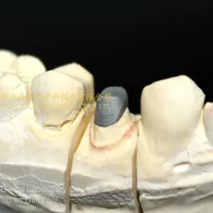 Full Metal Post Core, Full Ceramic Post Core, Richmond Crown, Cast Metal Crown, Dental Prostheses, Laboratorio Dental, Dental Laboratory, Dentallabor, LJ Dental Lab China thumbnail-1