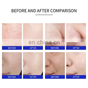 3 In1 Diamond Microdermabrasion Hydra Beauty Machine Facial Peeling Suction Oxygen Jet Skin Rejuvenation Dermabrasion Instrument thumbnail-5
