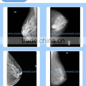 High Frequency Fixed or Rotating Anode Cheapest Mammography x Ray Price thumbnail-5