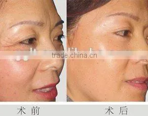 New Designed Bipolar RF Skin Tightening Face Lifting Beauty Equipment Price thumbnail-5
