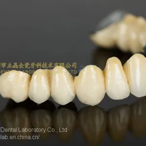 Dental Crown Porcelain Fused Metal, PFM, VMK, Dental Prostheses, Laboratoire Dentaire, Dentallabor, Laboratorio Dental, Dental Laboratory, Shenzhen LJ Dental Lab China thumbnail-1