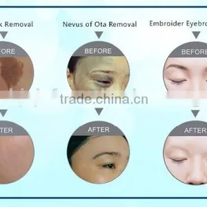 2016 Ruby Laser Tattoo Removal Machine With 6 Applications Strong Power Low Price thumbnail-4