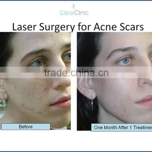 Acne Treatment Skin Rejuvenation Skin Tightening er Yag Laser Scar CO2 Laser thumbnail-6