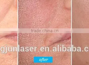 Fractional Co2 Laser Skin Resurfacing RF And Stretch Mark Removal Machine 40w thumbnail-2