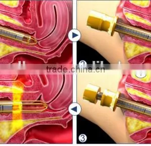 40w Clinic Use Co2 Fractional Laser Multifunctional Tumor Cutting Machine Vaginal Tighten Remove Neoplasms Skin Regeneration thumbnail-5