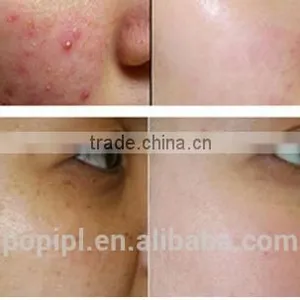 High Quality and Best Price Fractional C02 Laser Machine RF Excited Portable Design Fractional Producers Acne Treatment thumbnail-2