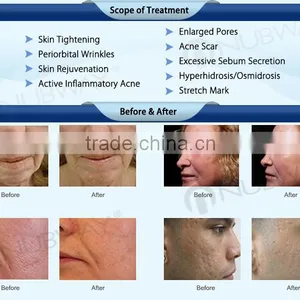 Best Laser Fractional Scarlet&wrinkle Removal&skin Rejuvenation Device thumbnail-4