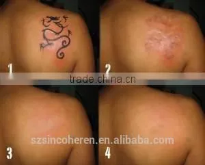 1064nm 532nm Laser Tattoo Removal Q-Switch ND YAG Laser thumbnail-6