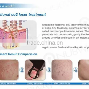 2016 Lowest Distributor Price: Super Pulse Co2 Laser for Skin Refreshing Scar Remov for Acne Scars Treatment , Burn Debridement thumbnail-5