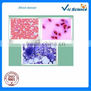 High Quality Medical Human Pathological Cancer Prepared Slides thumbnail-1