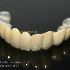 Dental Crown Porcelain Fused Metal, PFM, VMK, Dental Prostheses, Laboratoire Dentaire, Dentallabor, Laboratorio Dental, Dental Laboratory, Shenzhen LJ Dental Lab China thumbnail-2