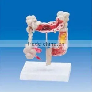 Colon and Rectum Model ,Colon and Rectum Common Disease Model thumbnail-1