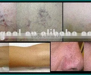 2015 High Quality Professional 980nm Diode Laser for One-time Remove Rosacea thumbnail-6