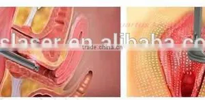 rf Tube Co2 Fractional Laser Apparatus for Vaginal Perfection With Imported RF Tube! thumbnail-2