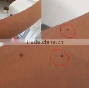 2016 New Product Co2 Laser Scar Removal Cost / Fractional Co2 Laser thumbnail-6