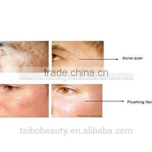 Radio Frequency RF Wrinkle Removal Machine Stretch Mark/best Skin Rejuvenation/ Skin Lifting Radio Frequency thumbnail-6