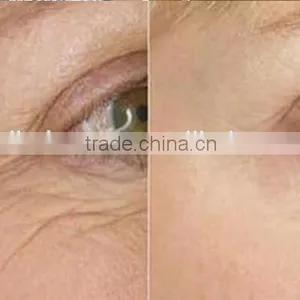 2016 Newest Portable Fractional RF Machine Radio Frequency/Best RF Skin Tightening Face Lifting Machine thumbnail-6